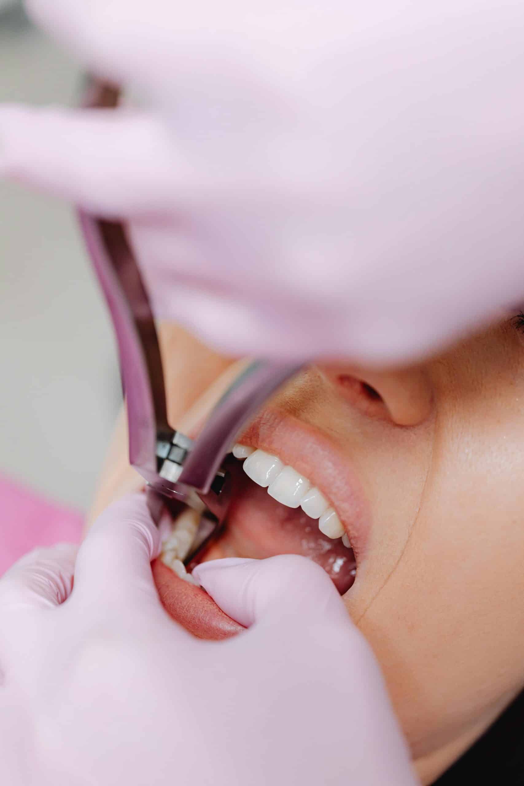 Patient undergoing tooth extraction in dentists office