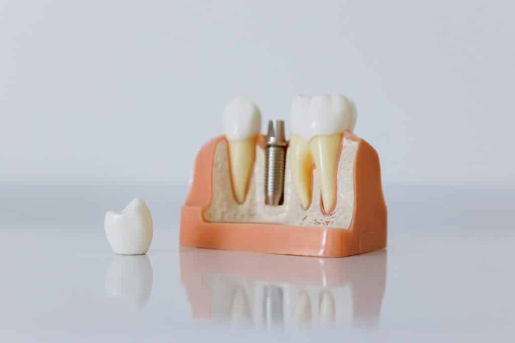 Dental Implant Aftercare