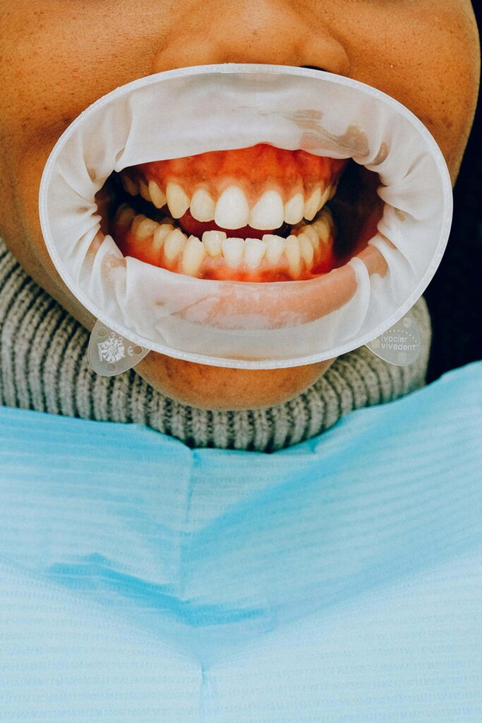Dental work on teeth and gums for gummy smile