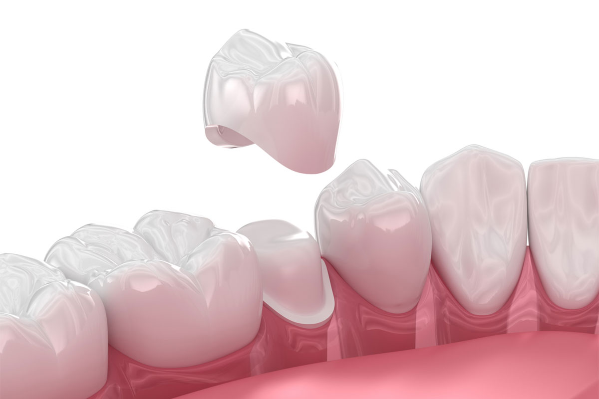 Dental crown being placed on a cracked tooth at MR Dental Aesthetics.