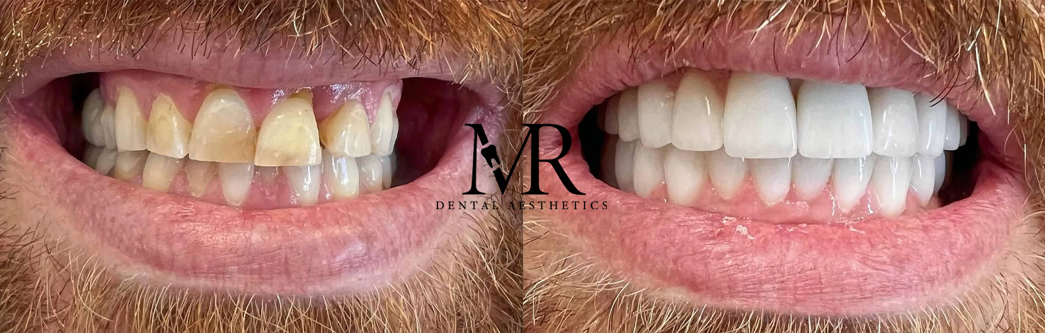 Before and after close-up of a smile restored with porcelain veneers Los Angeles, showing alignment and shade improvements.